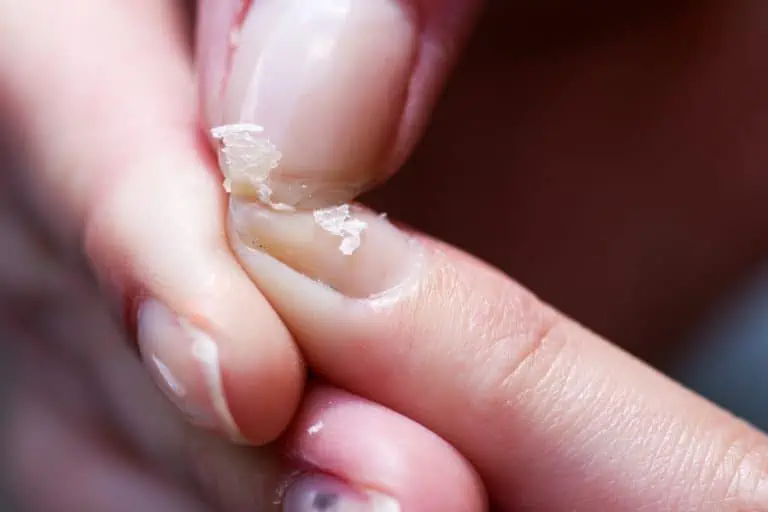beschadigde of broze nagels viscollageen